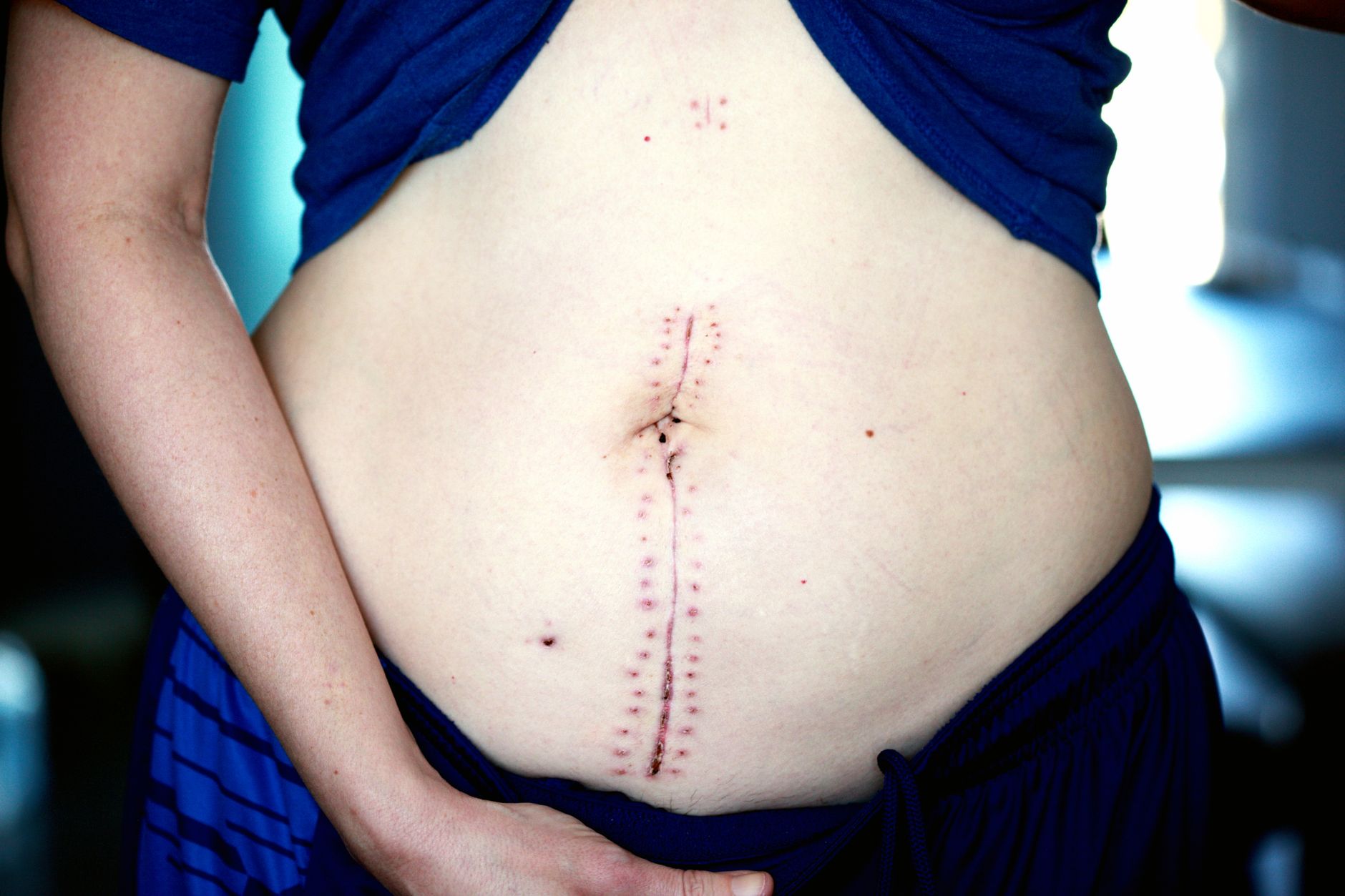 Advances in Robotic Surgery: Smaller Incisions, Faster Recovery